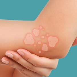 Ekcéma, atópiás dermatitis